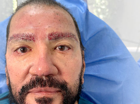 Implante de cejas