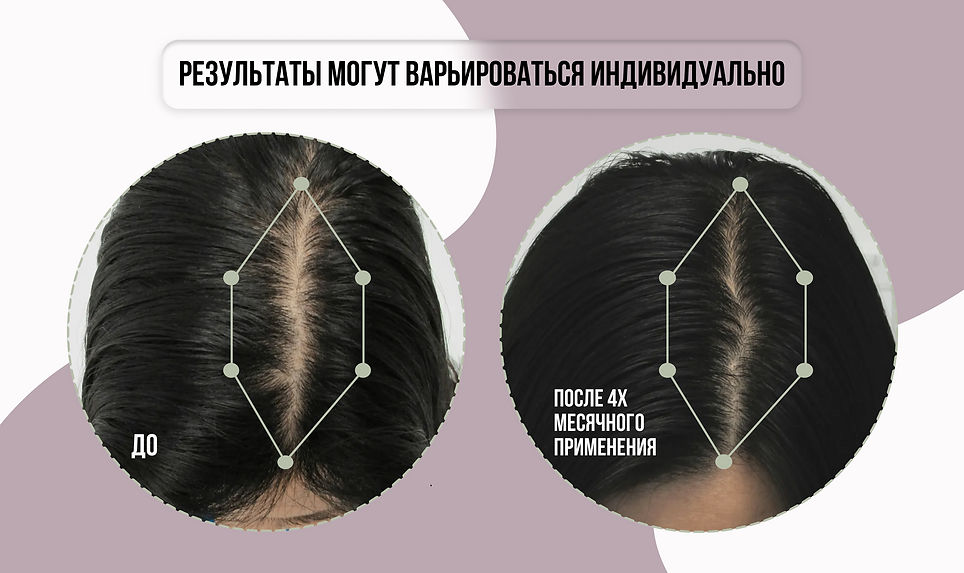 витамины против выпадения волос