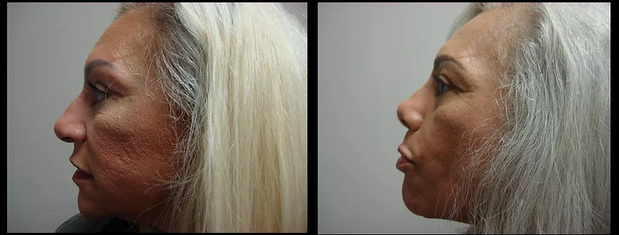 Rhinoplasty "Nose Job"