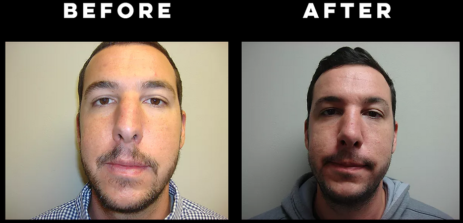 Rhinoplasty "Nose Job"