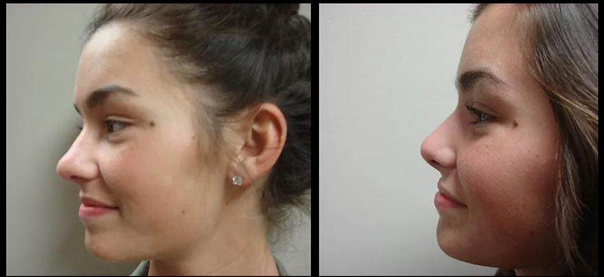 Rhinoplasty "Nose Job"