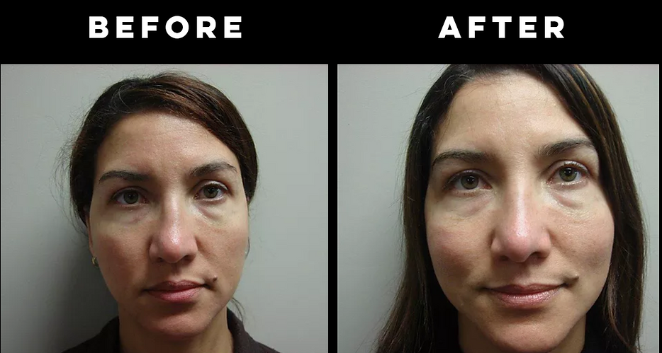 Rhinoplasty "Nose Job"