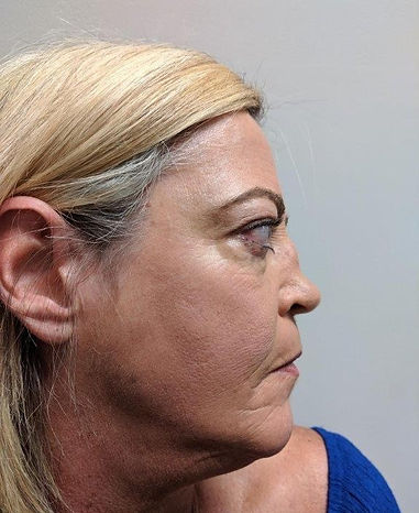 Rhinoplasty