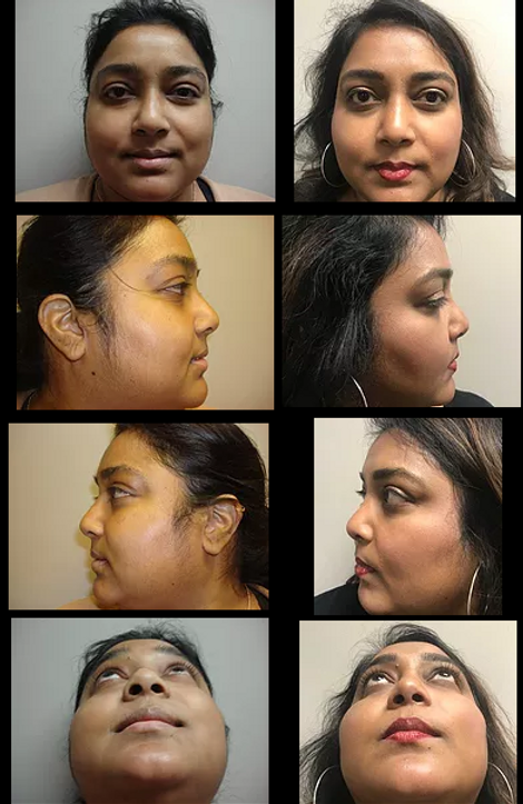 Rhinoplasty