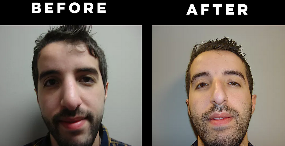 Rhinoplasty "Nose Job"