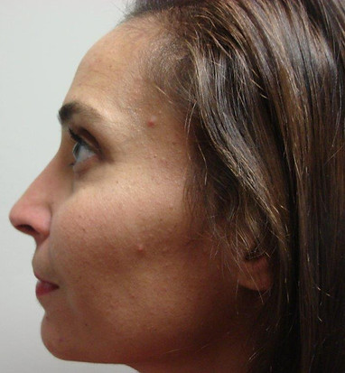 Rhinoplasty
