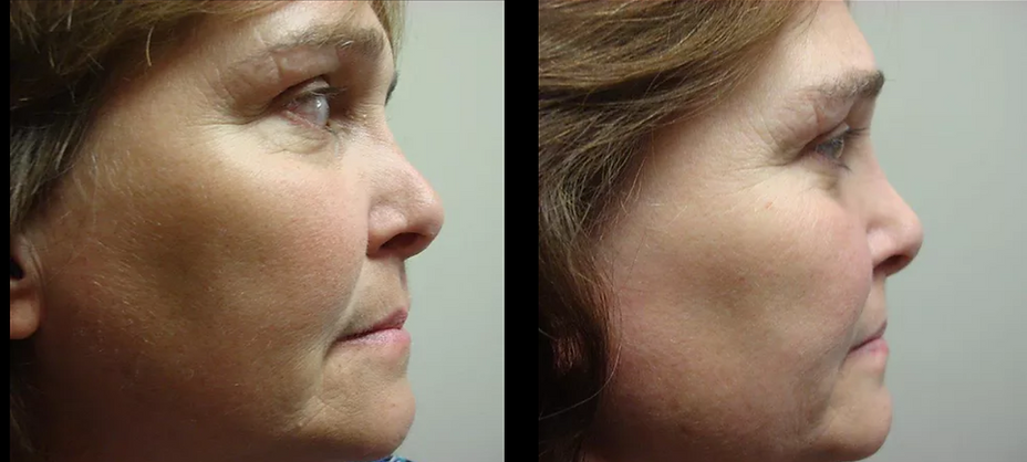 Rhinoplasty "Nose Job"