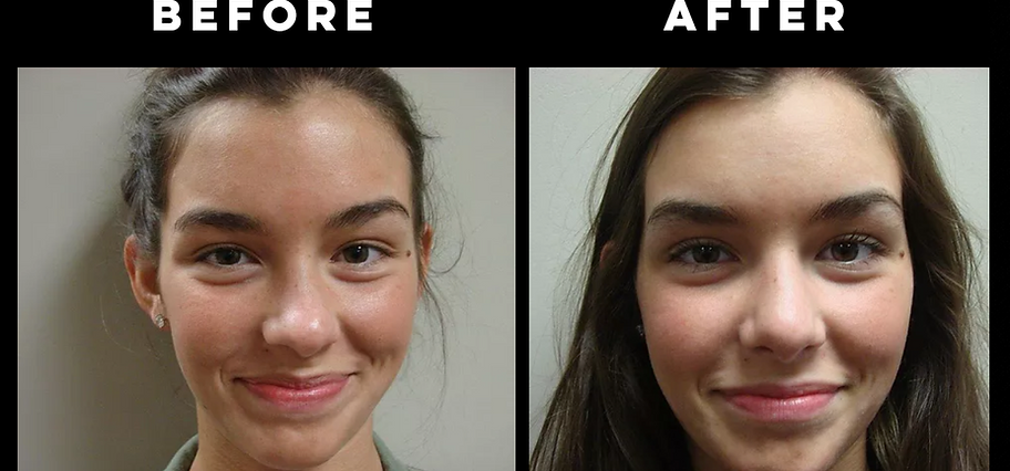 Rhinoplasty "Nose Job"