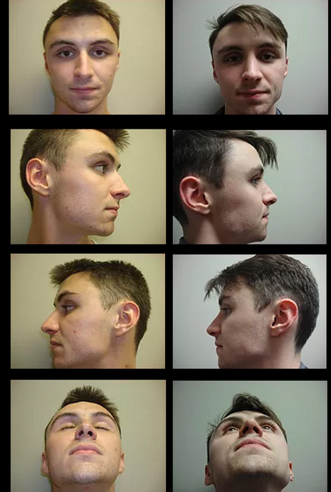 Rhinoplasty