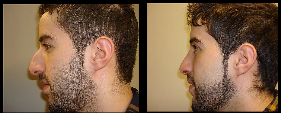 Rhinoplasty "Nose Job"