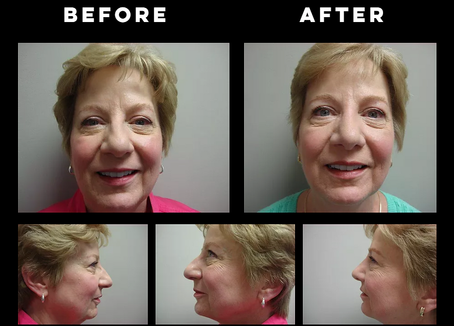 Rhinoplasty "Nose Job"