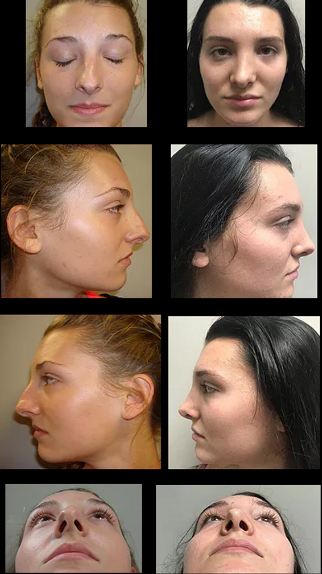 Rhinoplasty