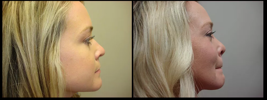 Rhinoplasty