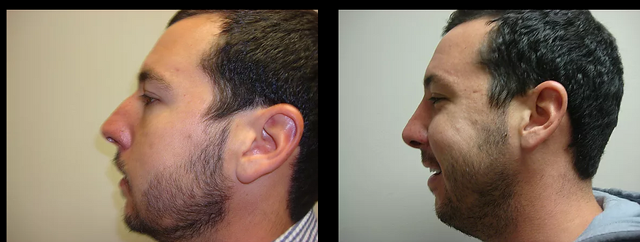 Rhinoplasty "Nose Job"