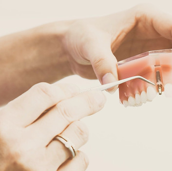 Dental implants_edited_edited.jpg