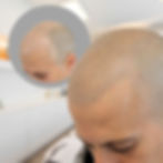 hair transplant repair
