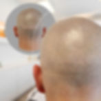 Hair transplant scar correction