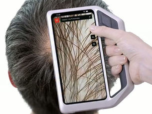 Digitale Haarmessung mittels Trichoskopie