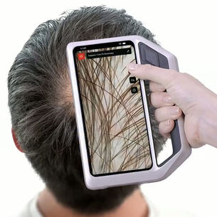 Digitale haarmeting door middel van trichoscopie