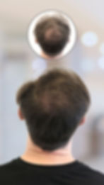 verdichting kruin na haartransplantatie te dun.jpg