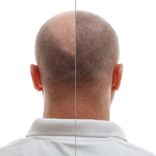 voor en na haar tattoo