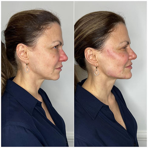 before-and-after-cheek-filler-3.jpeg
