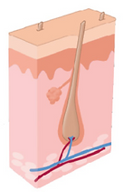 Laser Hair Removal Process