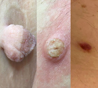 Skintag image.jpg