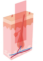 Laser Hair Removal Process