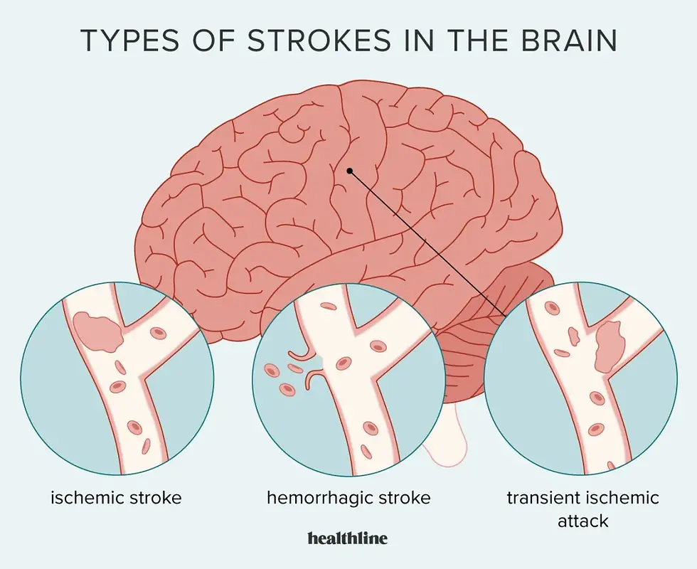 Types Of Strokes In The Brain