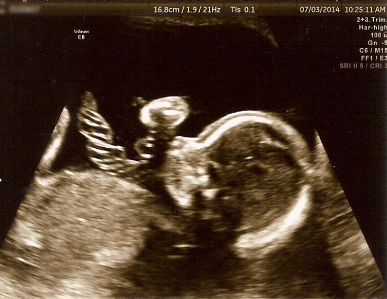 21 weeks-cord