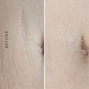 Stretch Mark and Stomach Tightening