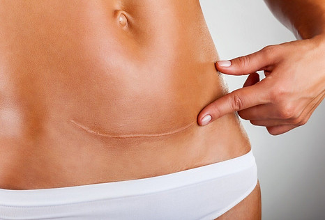 cesarean-scar-164252b5.jpeg