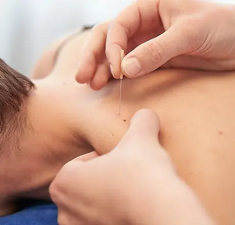 dry needling.webp