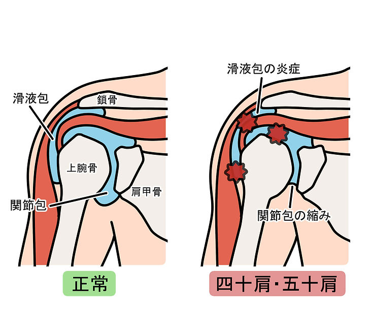 五十肩について