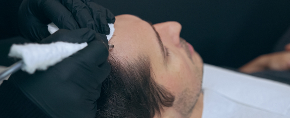 Scalp Micropigmentation
