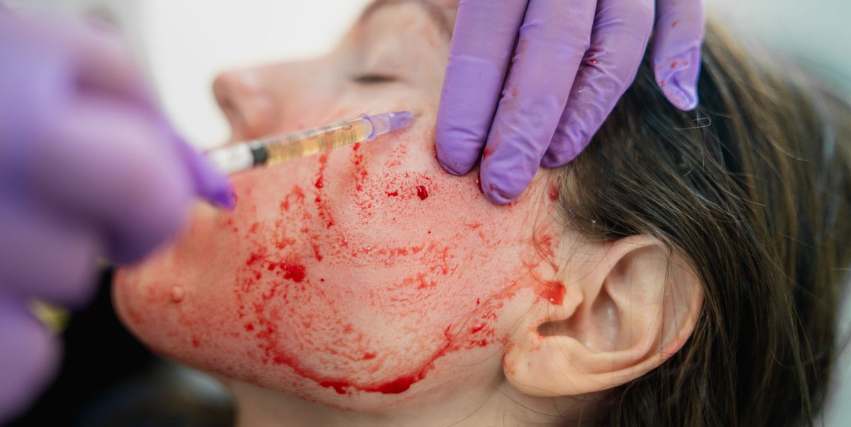 Vampire Face Lift