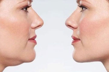 Non Surgical Fat Reduction