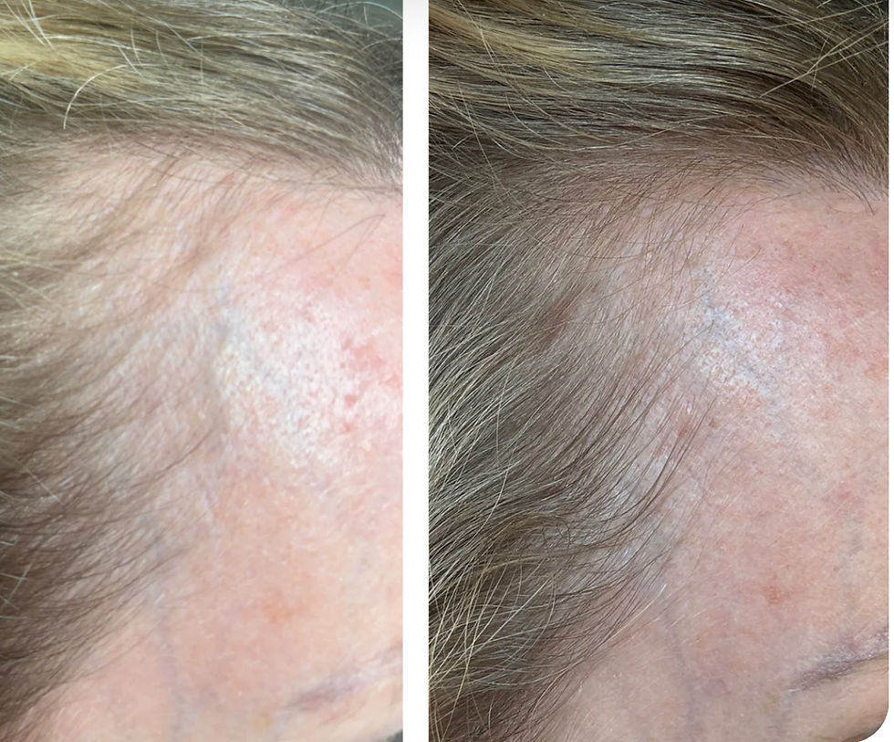 Thumbnail: Trudermal Halo LED Hair Growth System