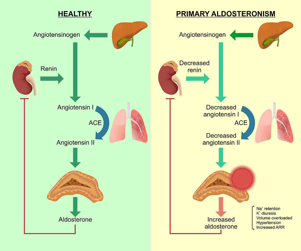 Figure VII (a): Healthy vs Primary Aldosteronism Illustration. The diagram compares normal physiology and primary aldosteronism. The left side shows a typical Renin-Angiotensin-Aldosterone System (RAAS) with organs: the liver, kidneys, lungs, and adrenal gland. Arrows indicate conversion: angiotensinogen to angiotensin I (via renin), then to angiotensin II (via ACE), stimulating aldosterone production. The right side shows altered RAAS in primary aldosteronism: decreased renin, decreased angiotensin I & II, but increased aldosterone production. Effects include sodium retention, potassium diuresis, volume overload, and hypertension.