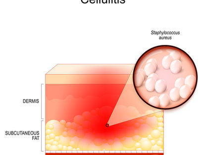 Cellulitis in Pets (Dogs and Cats): Causes, Warning Signs, Diagnosis, Treatment, and Prevention