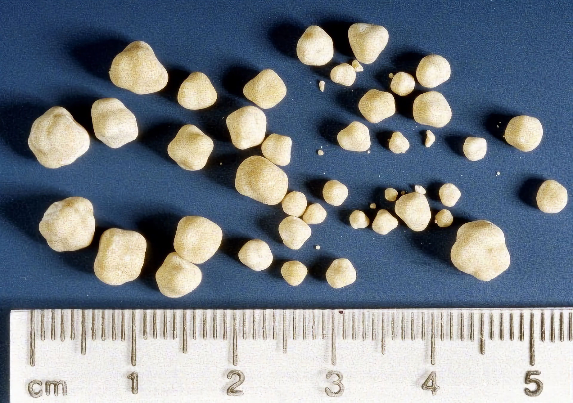 Urinary bladder stones