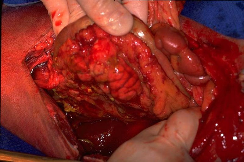 Pancreatitis