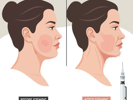 What Is “Ozempic Face”, And How Can It Be Treated?