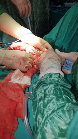Familial colonic polyposis