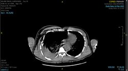 Flail chest - Ribs fixation 12-3-23 16