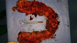 Familial colonic polyposis