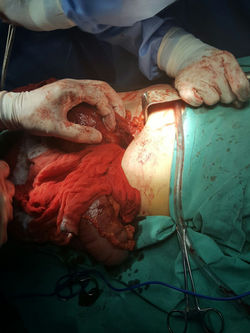 Pancreatic cyst