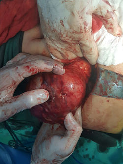 Pancreatic cyst