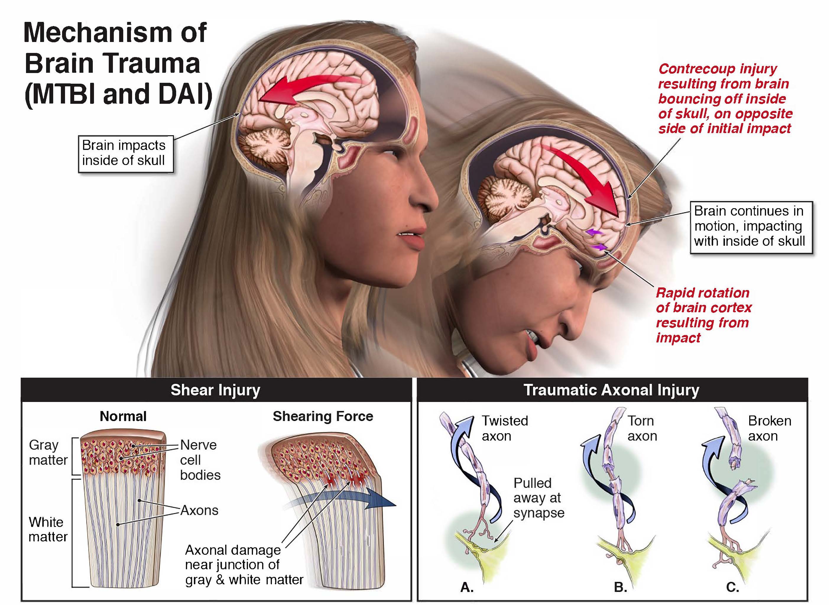 Litigating Mild Traumatic Brain Injury: What a family needs to know | The Law Offices of Charlie Waters | Dallas Personal Injury Attorney